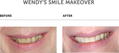 Weybridge Teeth Smile Makeover Teeth Makeover