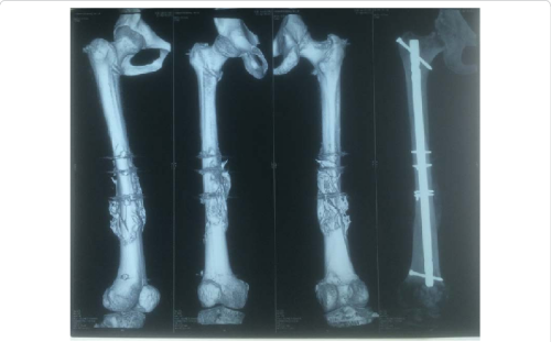 3d Ct Scan And X ray Of Femur With Accelerated Union Bone Fracture